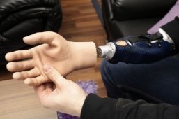 A bionic hand in many ways as good as a graft