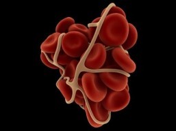 Blood clot removal boosts stroke risk in heart attack patients