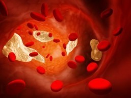 New technique for detecting hard arteries
